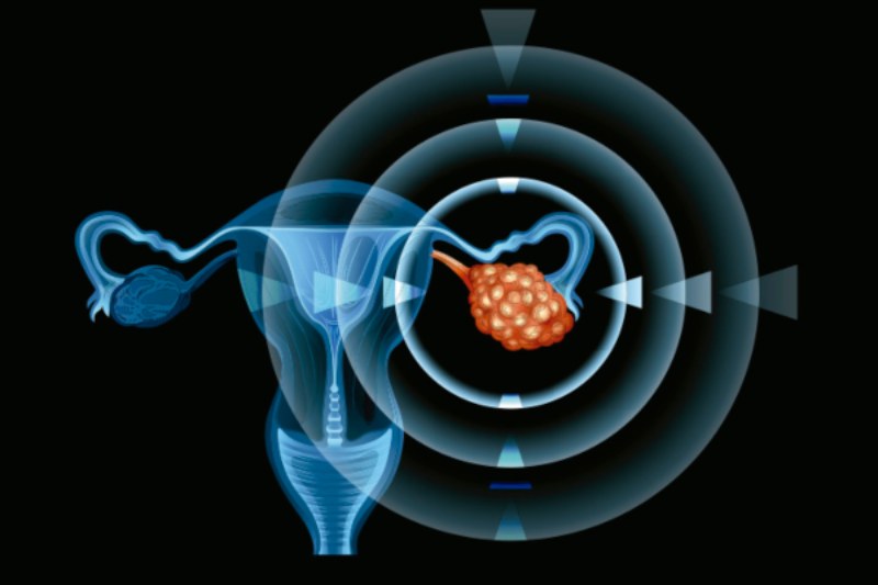 Cáncer de ovario: ¿Cómo cuidarse de esta enfermedad?